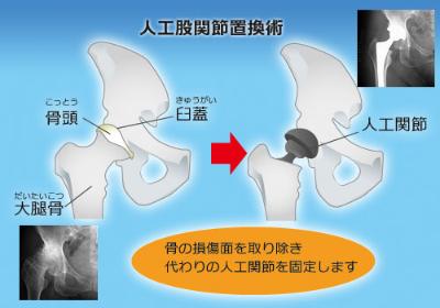 人工関節置換術の図説　「骨の損傷面を取り除き代わりの人工関節を固定します」