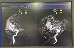 写真：IVR-CT/Angioシステムの画像