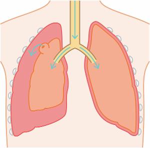気胸になった肺のイラスト。
