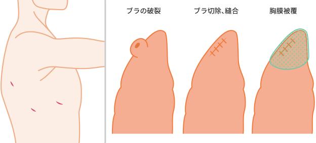 原発性自然気胸の手術時に胸腔鏡を挿入する体の側面3か所の位置、並びに肺のブラの破裂の様子、ブラ切除・縫合と胸膜被覆の各手術方法の肺の図説。