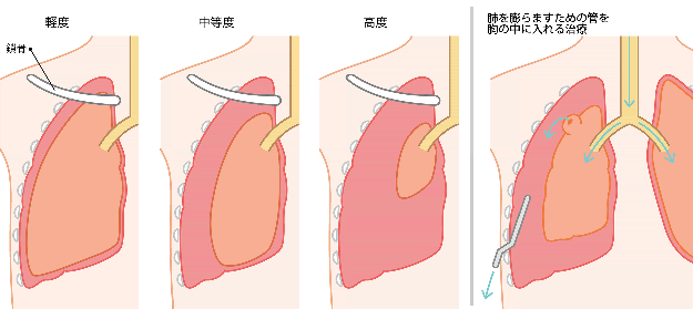 気胸の症状の度合いの違いと、肺を膨らますための管を胸の中に入れる治療のイラスト。