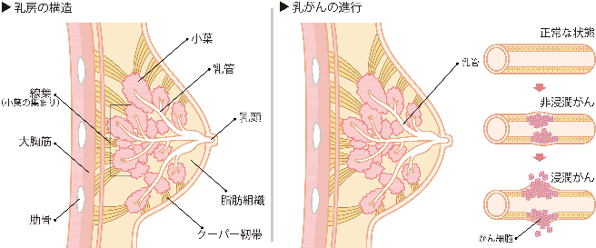 乳房の構造のイラストと、乳がんの進行状態を表したイラスト。非浸潤がんはがん細胞が乳管内に留まっている状態のこと。浸潤がんは非浸潤がんの状態からがん細胞が乳管を突き破っている状態のこと。