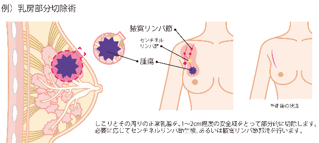 乳房部分切除術の例における、切除する箇所と手術後の状態の図説。しこりとその周りの正常乳腺を、1から2センチメートル程度の安全域をとって部分的に切除します。必要に応じてセンチネルリンパ節生検、あるいは腋窩リンパ節郭清を行います。