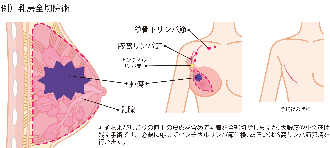 乳房全切除術の例における、切除する箇所と手術後の状態の図説。乳頭およびしこりの直上の皮膚を含めて乳腺を全部切除しますが、大胸筋や小胸筋は残す手術です。必要に応じてセンチネルリンパ節生検、あるいは腋窩リンパ節郭清を行います。