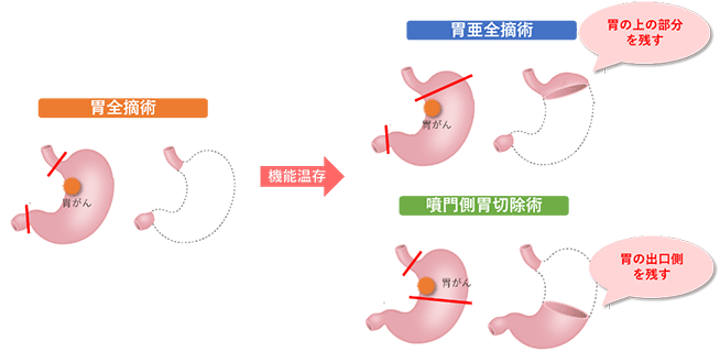 画像は、胃の上部にできた胃がんに対する各術式の胃切除具合を表したイラストです。胃全摘術では胃を全て取り除きますが、機能温存手術である胃亜全摘術では胃の上の部分を残し、噴門側胃切除術では胃の出口側を残します。