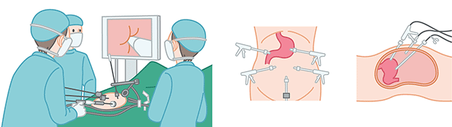 画像は、腹腔鏡手術の様子と腹腔鏡を挿入するポートの位置を示すイラストです。この図説では胃の手術にあたり、腹部の数ヶ所から内視鏡を挿入し、モニターで内視鏡からの映像を見ながら手術を進めています。