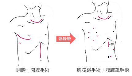 画像は、開胸+開腹手術の場合の傷の大きさや位置と、胸腔鏡手術+腹腔鏡手術の場合の傷の大きさや位置を表したイラストです。前者に比べて後者のほうが傷が大きくはなく、低侵襲に手術を行うことができます。