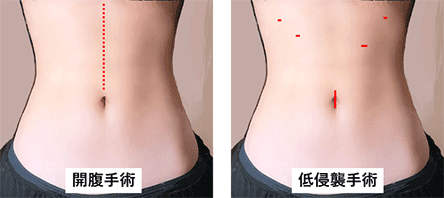 写真は、開腹手術と低侵襲手術がそれぞれ体にできる傷の大きさと位置を示しています。開腹手術は上腹部に大きな傷ができます。低侵襲手術ではへそとその上部に数か所小さな傷で手術を行うことができます。