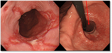 写真は、通常の食道胃吻合術後の内視鏡で撮影した胃の内部です。