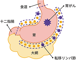 胃の入口側（噴門部）にできた進行がんの場合の切除範囲の図説。