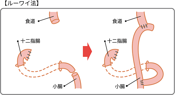 ルーワイ法での接合方法の図説。胃を摘出した後、十二指腸から伸びた小腸を切断して食道につなげ、残った十二指腸を小腸の途中につなげ直します。