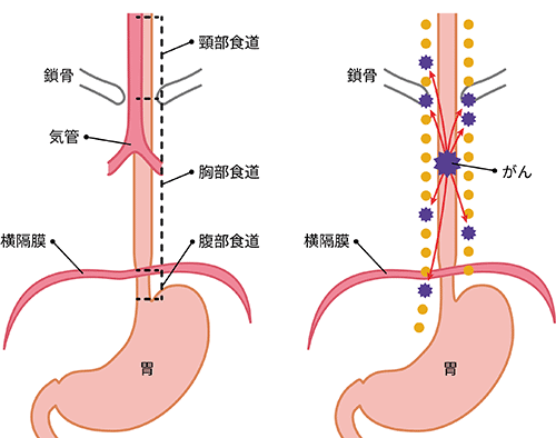 食道まわりの名称の図と、食道がんが発症した際の食道以外へのがんの転移を示した図。