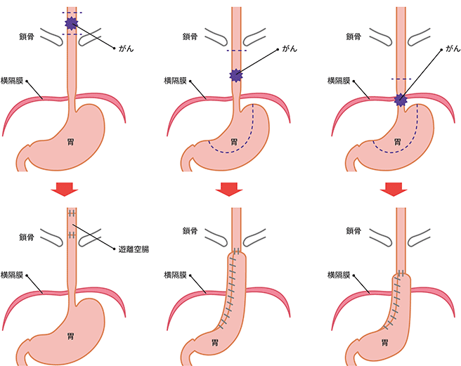 食道のどの位置にがんが発生するかによる、外科的切除と吻合の図説。