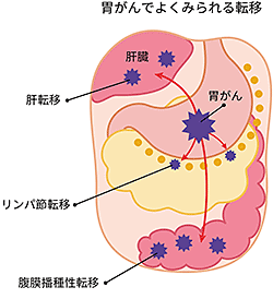 胃がんでよくみられる転移のイラスト。肝転移、リンパ節転移、腹膜播種性転移などがある。