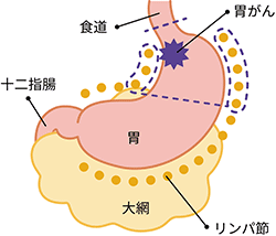 胃の入口側（噴門部）にできた早期がんの場合の切除範囲の図説。