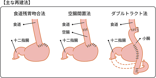 胃の入口側（噴門部）にできた早期がんの場合の主な再建法の内、食道胃の入口側（噴門部）にできた早期がんの場合の主な再建法の内、食道残胃吻合法、空腸間置法、ダブルトラクト法での接合方法の図説。