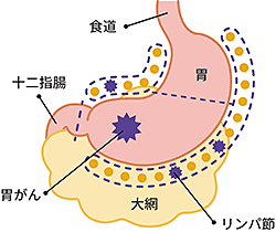 胃の出口側（幽門側）にできたがんの場合の切除範囲の図説。