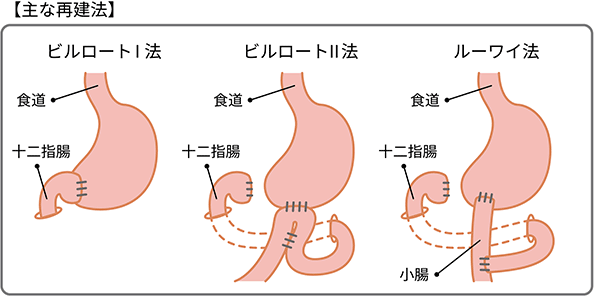 胃の出口側（幽門側）にできたがんの場合の主な再建法であるビルロート1法、ビルロート2法、ルーワイ法の図説。