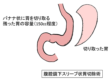 画像は、腹腔鏡下スリーブ状胃切除術で行う内容を表したイラストです。