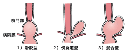 画像は、食道裂孔ヘルニアの分類を表したイラストです。滑脱型は、噴門部が横隔膜より胸腔に飛び出します。傍食道型は、胃の一部が横隔膜より胸腔に飛び出します。混合型は、先の2種類が混合した形態を示します。