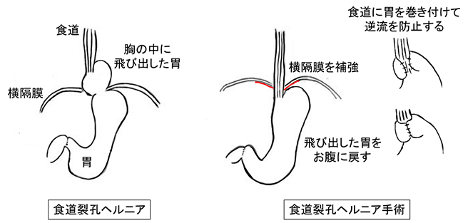 画像は、食道裂孔ヘルニアの手術内容を表したイラストです。