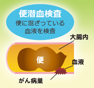 便潜血検査のイメージ画像　便に混ざっている血液を検査