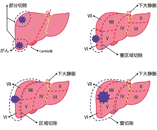 各肝切除の方法の図説。