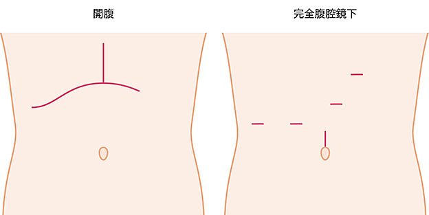 開腹手術と腹腔鏡手術の傷の位置の図説。