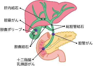 胆道の各疾患発症位置の図説。