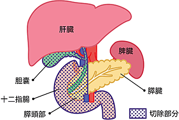 膵頭十二指腸切除術の切除部分の図説。