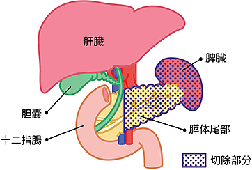 膵体尾部切除術の切除部分の図説。